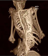 scheletro fibrodysplasia ossificans progressiva