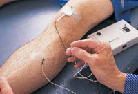 elettromiogramma emg braccio