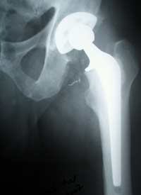 radiografia anca e protesi