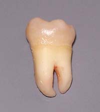 dente del giudizio o terzo molare