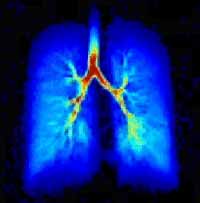 risonanza magnetica polmoni con elio