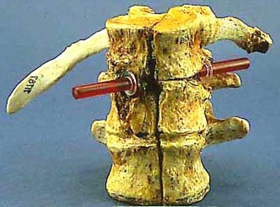 Garfield vertebre T12, L1 e L2