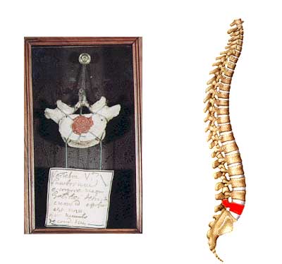 vertebra l5 galileo galilei