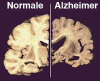 sezione cervello alzheimer