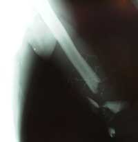 radiografia braccio