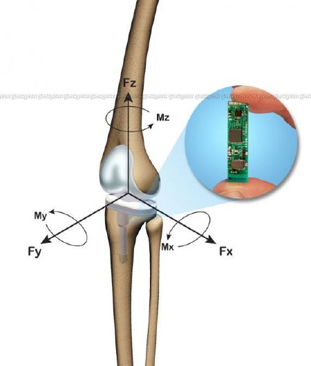 sensore wireless protesi ginocchio