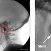 stent carotide