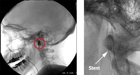 stent carotide