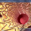 stent coronarico