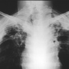 radiografia tubercolosi