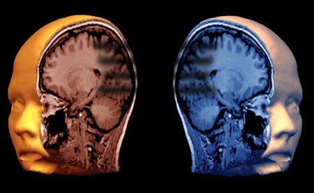 cervello parkinson