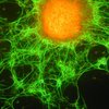Cellule staminali cancerogene tumorali