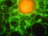 Cellule staminali cancerogene
