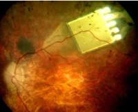 impianto retina chip