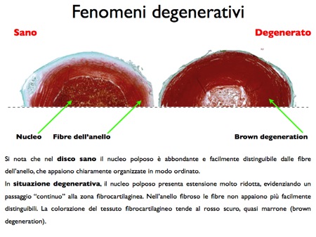 disco sano degenerato