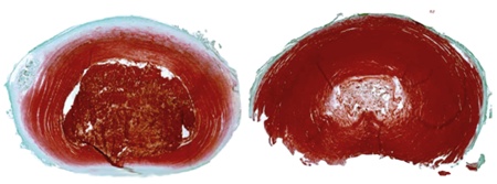 Disco intervertebrale sano e degenerato
