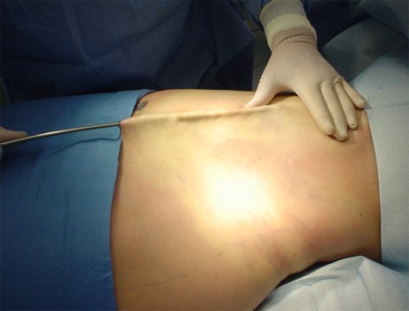 liposuzione chirurgia estetica