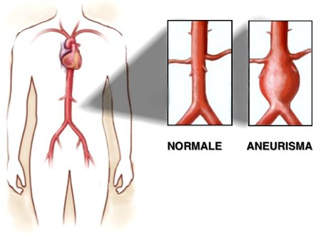 aneurisma aortico arteria toracica