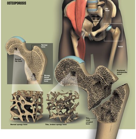 degenerazione ossa osteoporosi