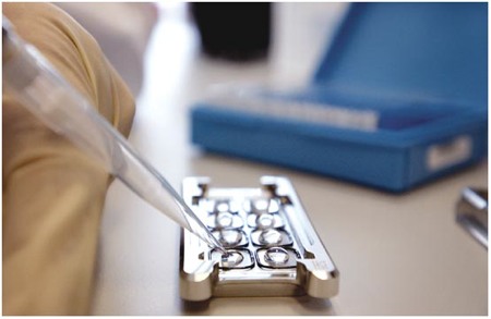 mammaprint test cancro al seno