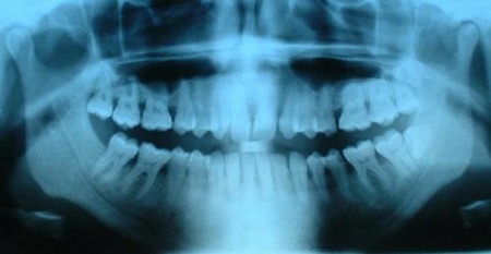 raggi-x radiografia denti