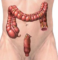 colostomia