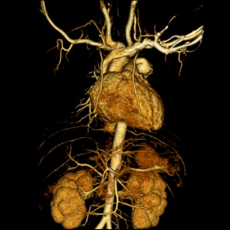 tac cuore vene arterie