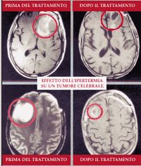 terapia ipertermica tumore cervello