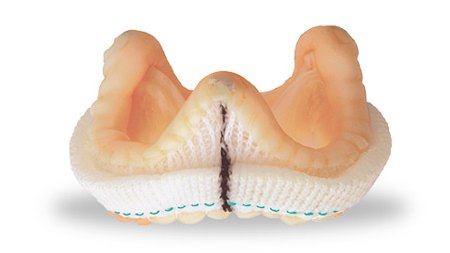 valvola porcina anti calcificazione