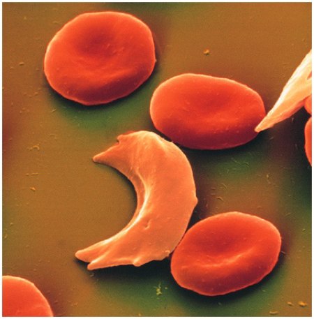 anemia falciforme drepanocitica