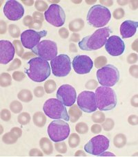 cellule staminali leucemia