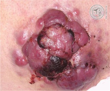 cancro tumore virus pelle