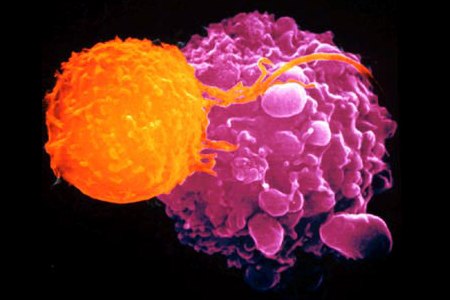 cellula cancro linfoma globuli bianchi