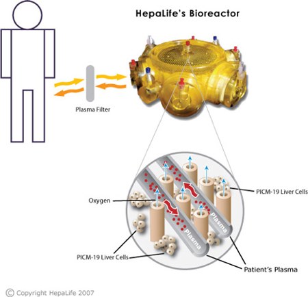 HepaLife fegato artificiale