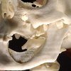 protesi scaffold mandibola staminali