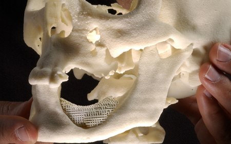 protesi scaffold mandibola staminali