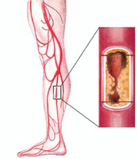 malattie vascolari periferiche arterie