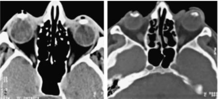 osteo odonto cherato protesi cornea