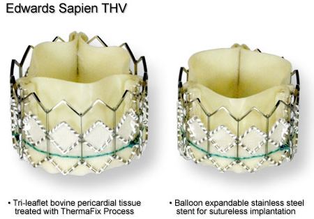 Valvola cardiaca transcatetere