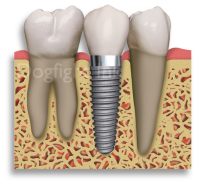 impianti dentali ricoperti di osso sintetico