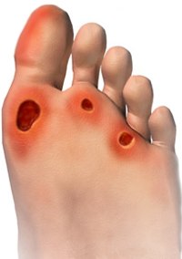 piede diabetico