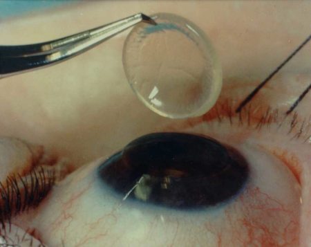 trapianto cornea