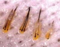 trapianto capelli