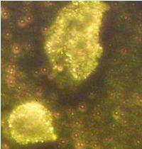 nanoparticelle contro cellule tumorali cancro