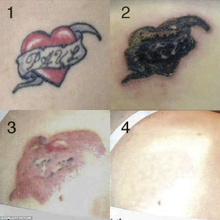 rimuovere tatuaggio rejuvi