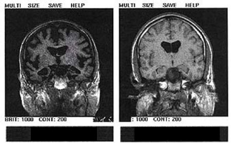 alzheimer alzheimer cervello risonanza magnetica