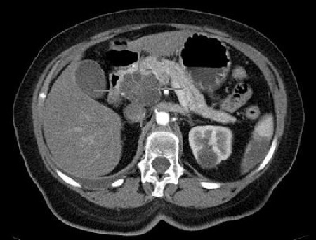 risonanza tumore pancreas