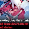 infarto cuore arterie fumo sigarette