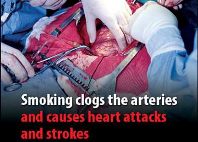 infarto cuore arterie fumo sigarette