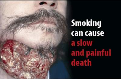 cancro gola fumo sigarette
